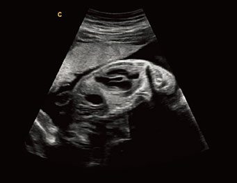 胎儿心脏，B 模式