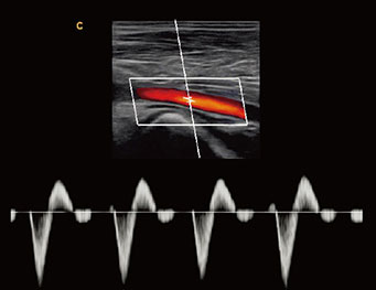 股动脉， PW 模式
