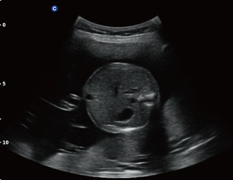 胎儿腹部， B 模式