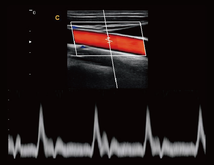 颈动脉，D 模式