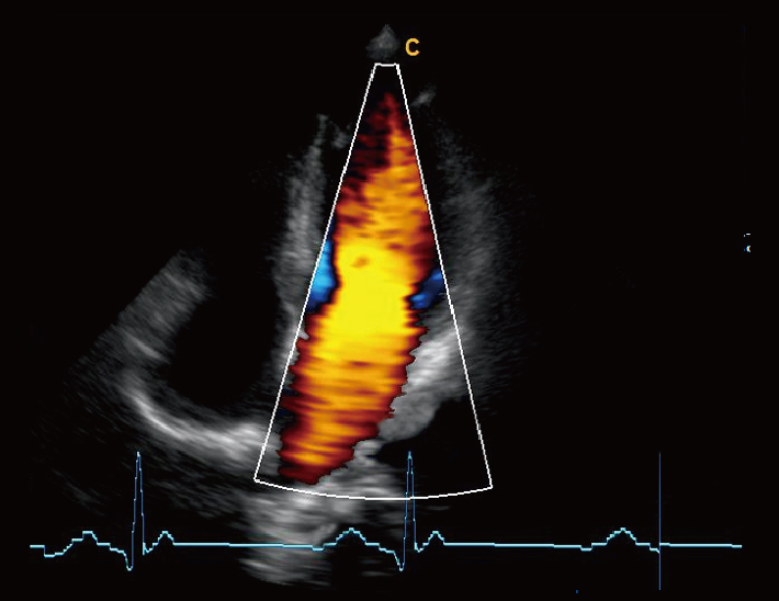 心脏，ECG