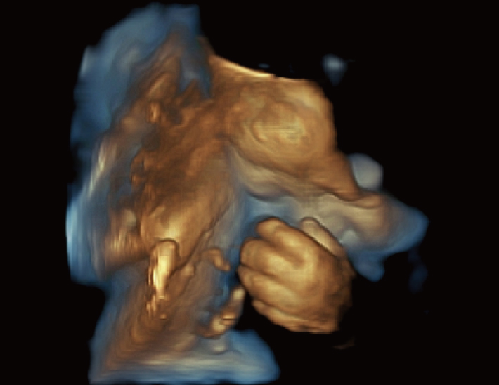 胎儿， 4D（景深成像）