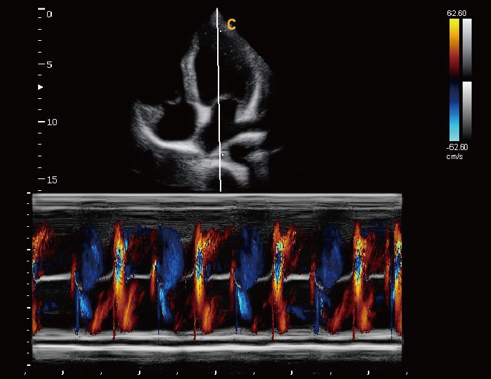 心尖四腔, 彩色 M 模式