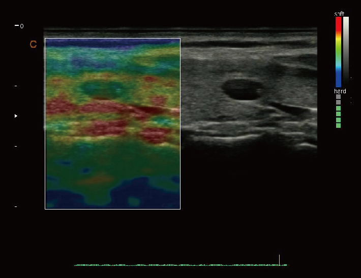 甲状腺结节，弹性成像