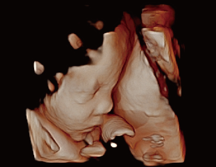 胎儿， 4D（高清成像）