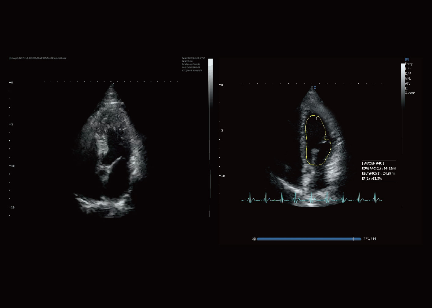 射血分数(EF) 射血分数(EF)