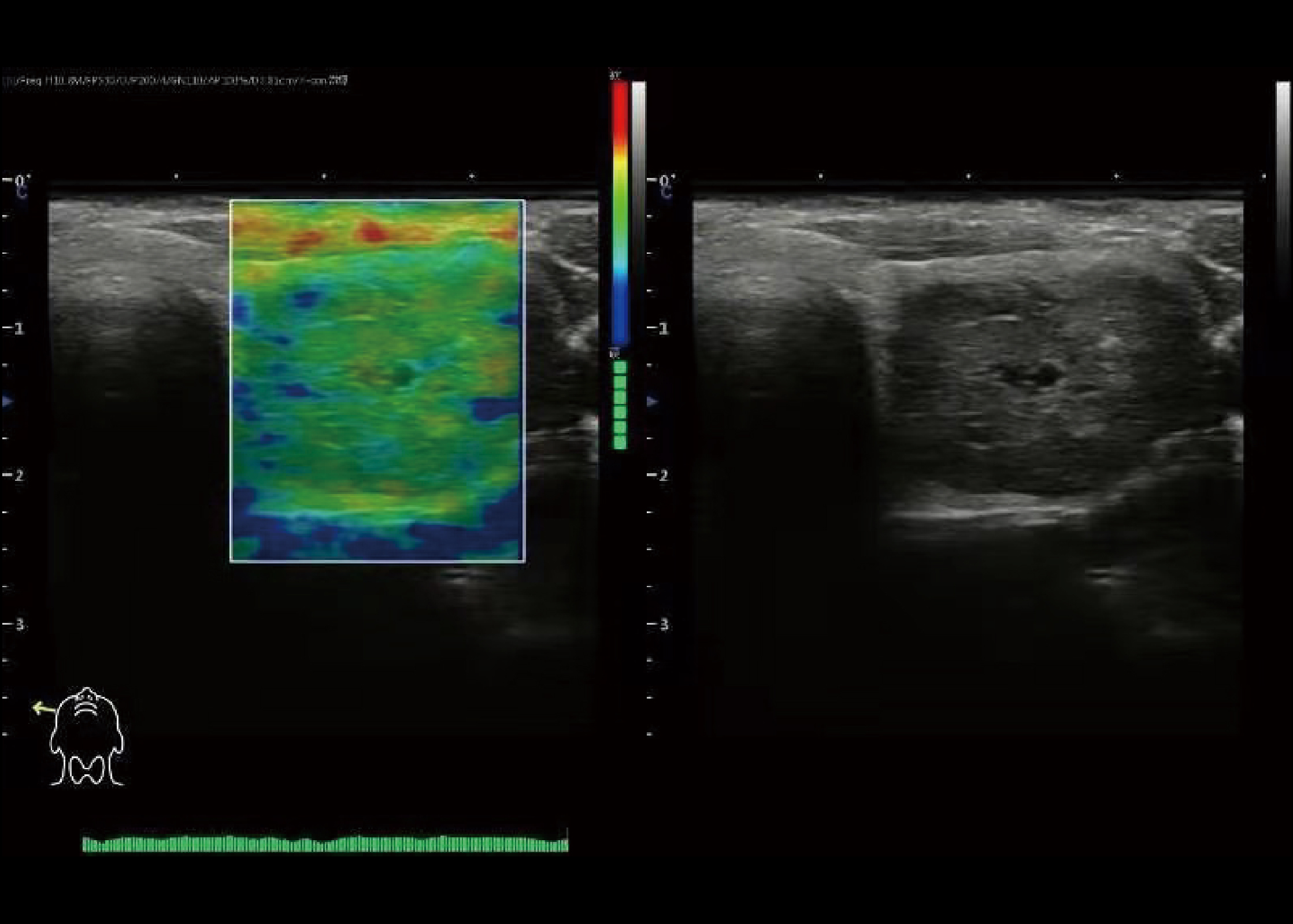 弹性成像（Elastography）