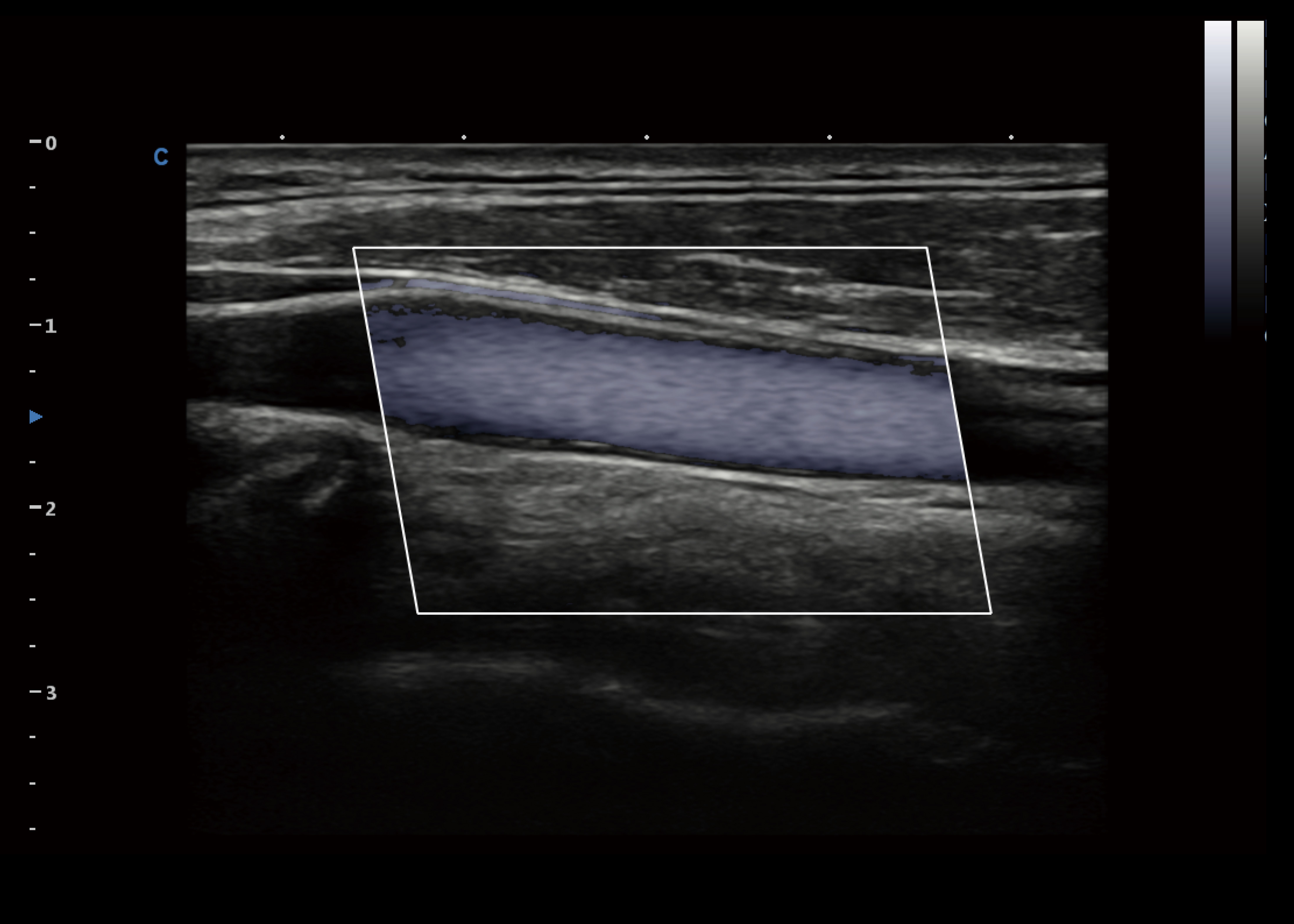 灰阶血流(Sound Flow) 灰阶血流(Sound Flow)