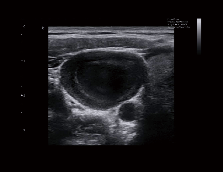 颈部包块，B模式