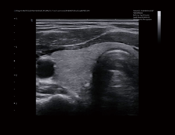 甲状腺，B模式