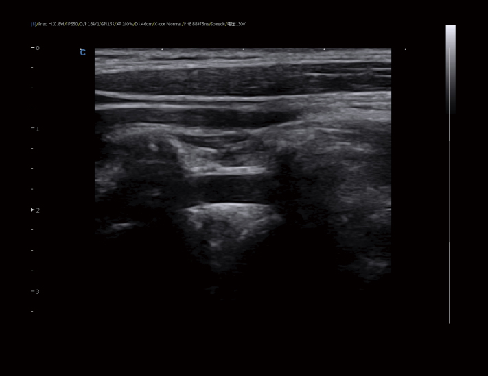 椎动脉，B模式