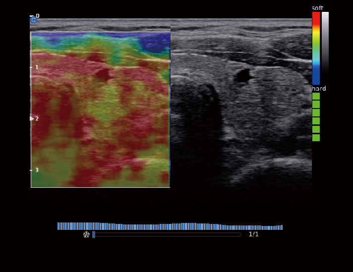 甲状腺，Elastography模式