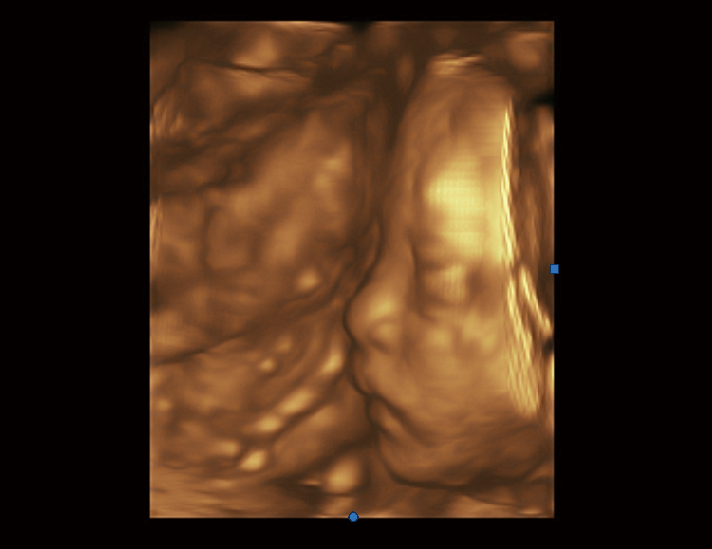 胎儿，4D模式