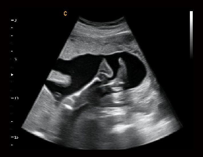 胎儿，B模式