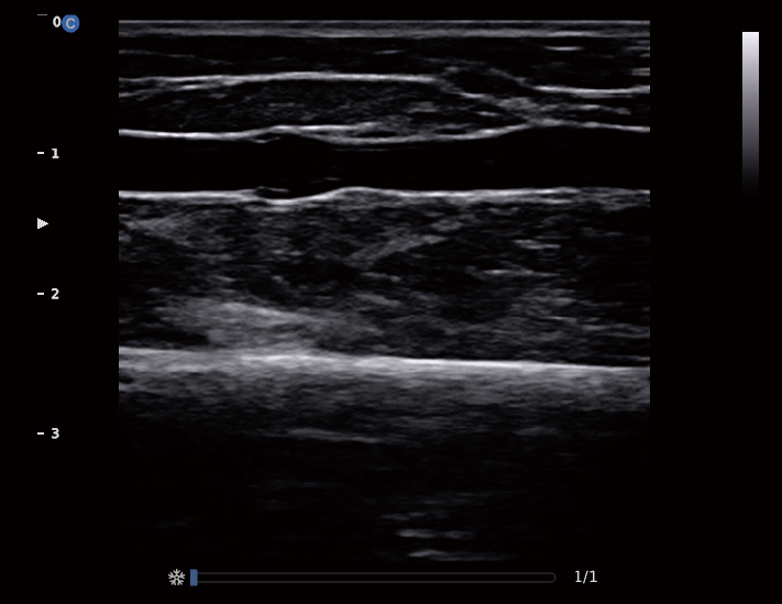 浅表血管，B模式