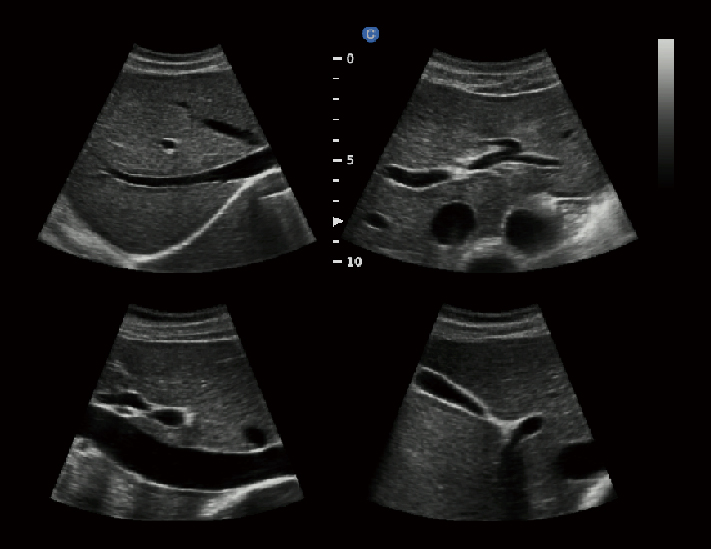 肝脏，B模式