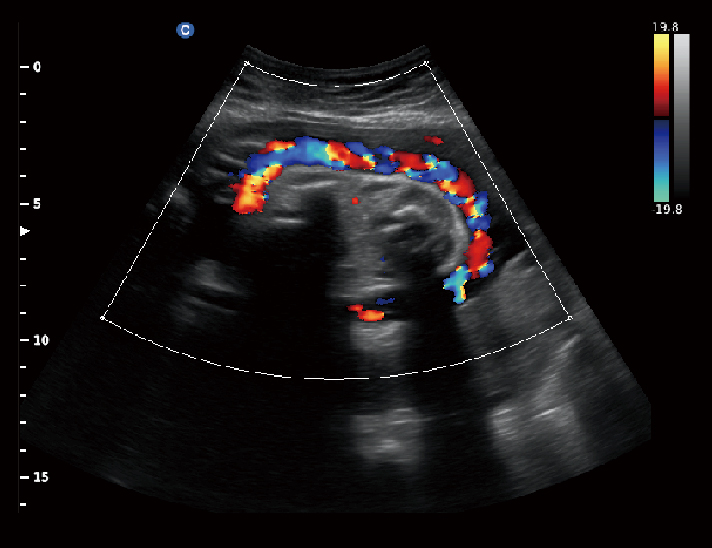 胎儿 脐带，C模式