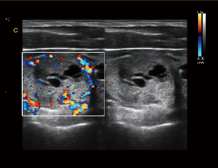 甲状腺结节，BC模式