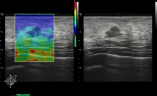 Elastography by XBit 90