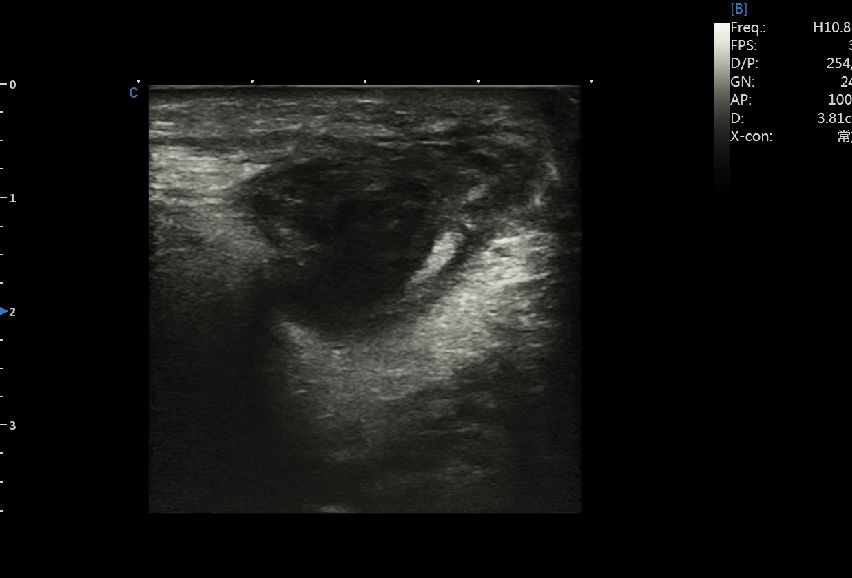 Ultrasound guided puncture of subcutaneous tumor in the neck