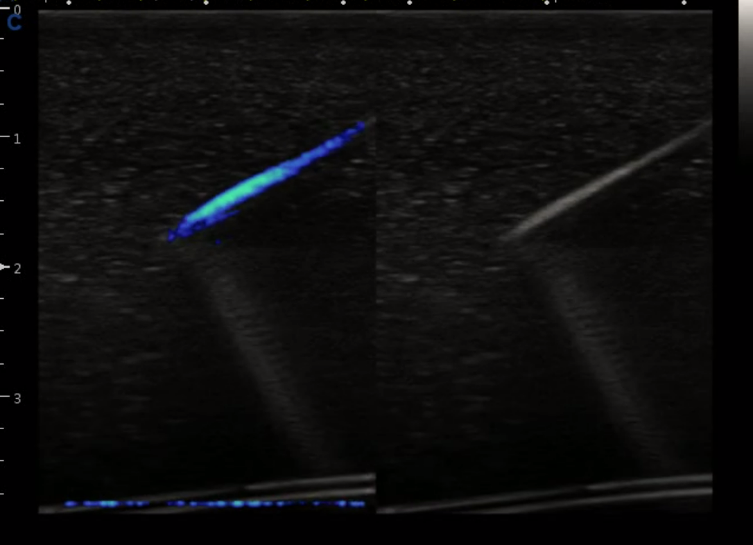 Ultrasound guided puncture of subcutaneous tumor in the neck