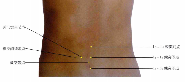 Ultrasound Guided Treatment of Lumbar Disc Herniation