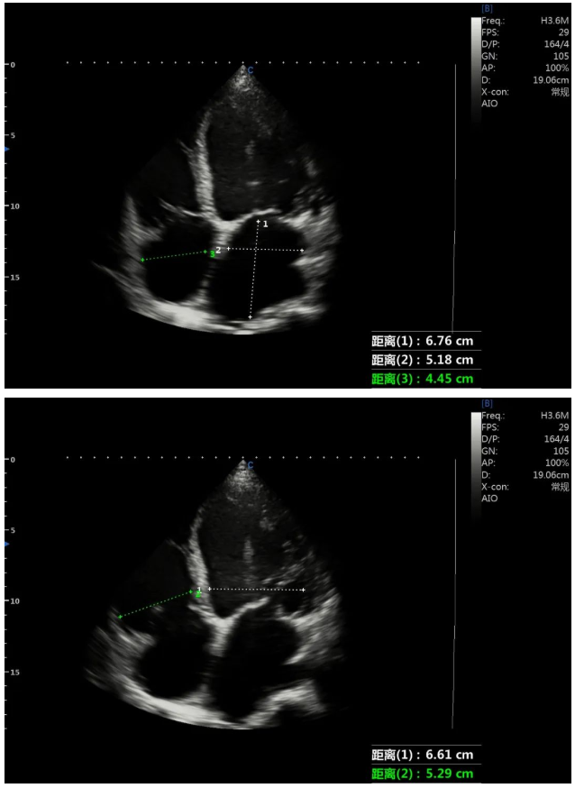 Case Report|A Case of Dilated Cardiomyopathy