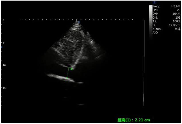 Case Report|A Case of Dilated Cardiomyopathy