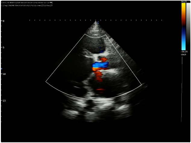 Case Report|A Case of Dilated Cardiomyopathy