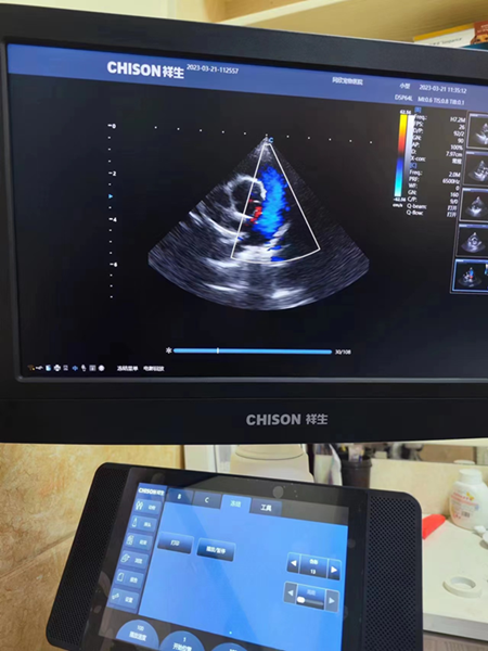 CHISON Handheld Ultrasound SonoEye