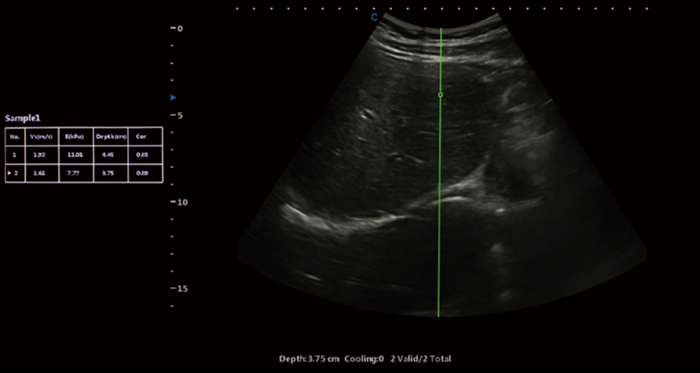 Shear Wave Elastography in Ultrasound: A Breakthrough in Diagnostic Imaging