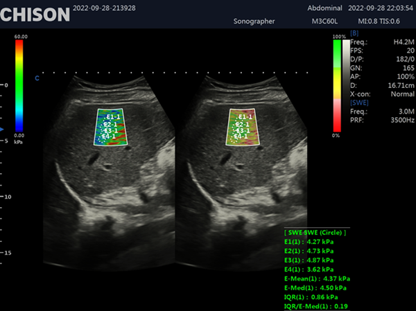 Shear Wave Elastography in Ultrasound: A Breakthrough in Diagnostic Imaging