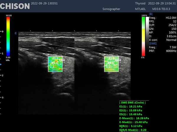 Shear Wave Elastography in Ultrasound: A Breakthrough in Diagnostic Imaging