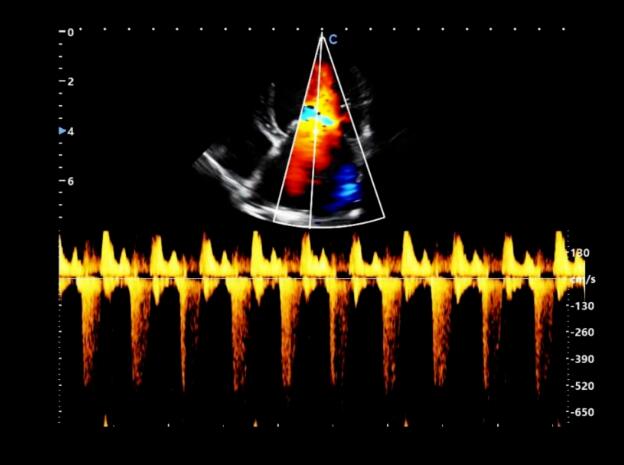 Animal Case Sharing | Myxomatous Mitral Valve Disease in Canine