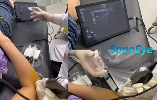Ultrasound-guided joint injectionss