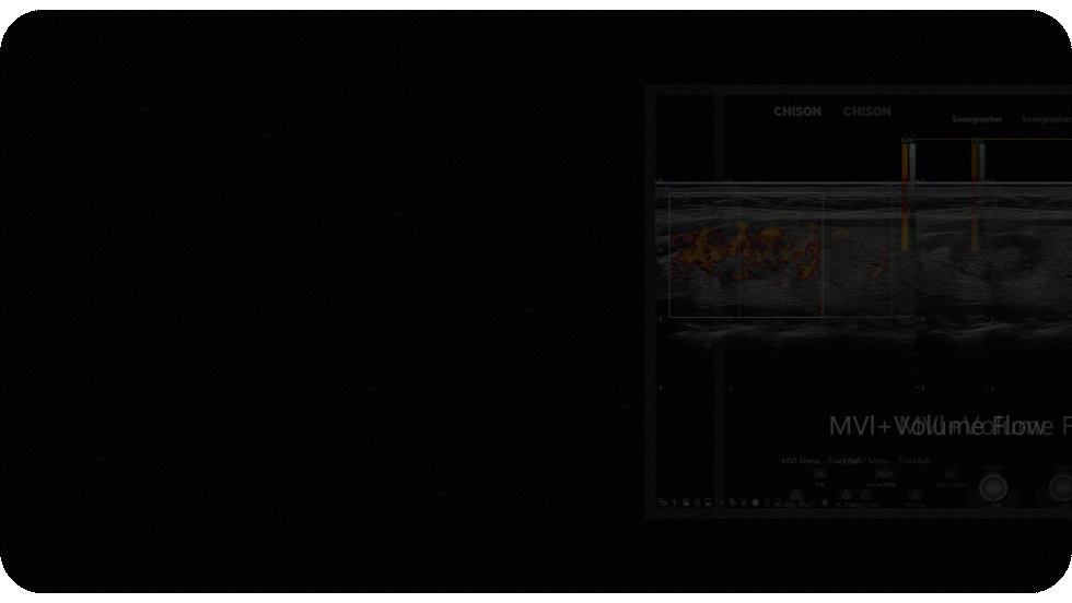 CHISON SonoPort | New Generation intelligent Cart-based Ultrasound System