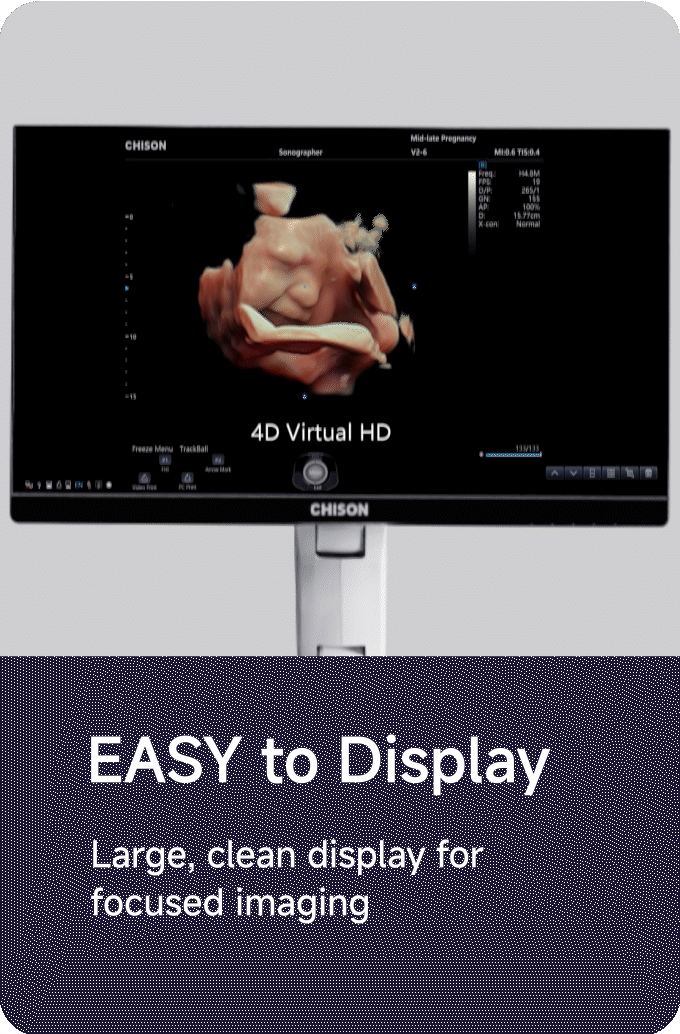 CHISON SonoPort | New Generation intelligent Cart-based Ultrasound System