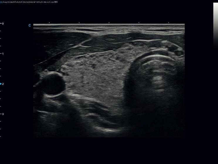 When the Thyroid Has No Nodules: An Ultrasound Case of Diffuse Thyroid Disease