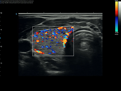 When the Thyroid Has No Nodules: An Ultrasound Case of Diffuse Thyroid Disease