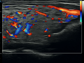 When the Thyroid Has No Nodules: An Ultrasound Case of Diffuse Thyroid Disease