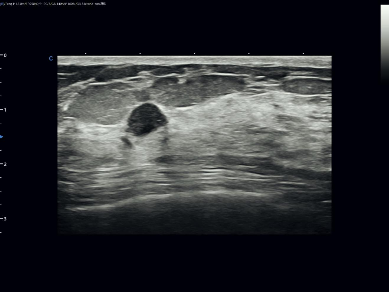 Reading a Small Breast Nodule with Confidence Reading a Small Breast Nodule with Confidence