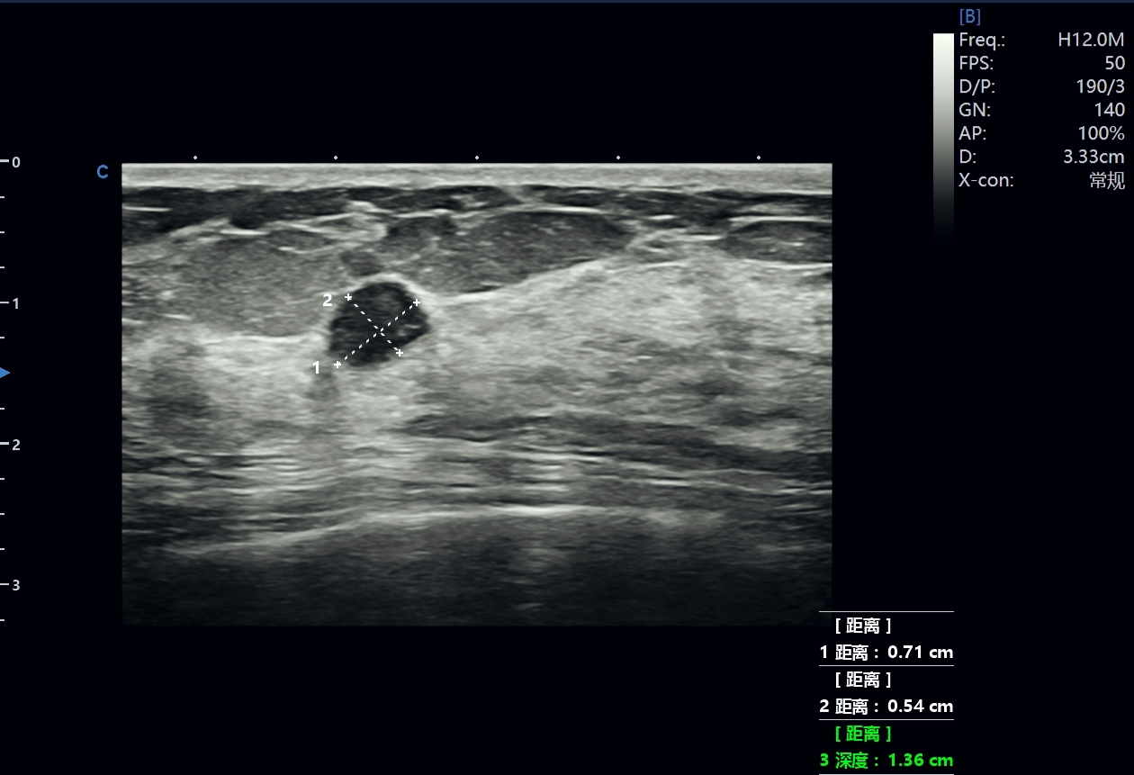 Reading a Small Breast Nodule with Confidence Reading a Small Breast Nodule with Confidence
