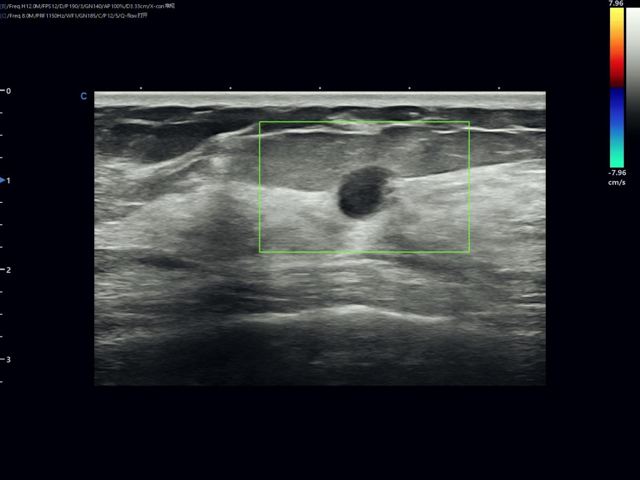 Reading a Small Breast Nodule with Confidence Reading a Small Breast Nodule with Confidence