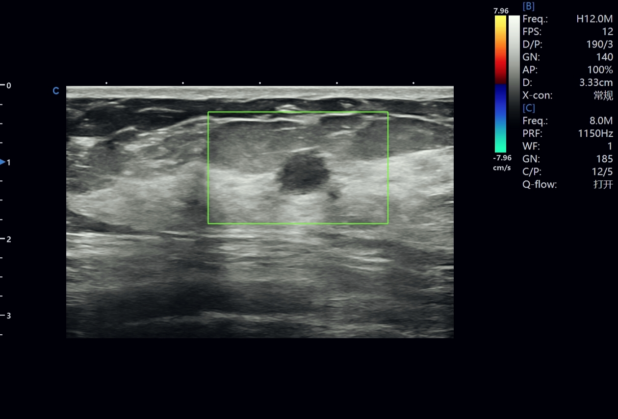 Reading a Small Breast Nodule with Confidence Reading a Small Breast Nodule with Confidence