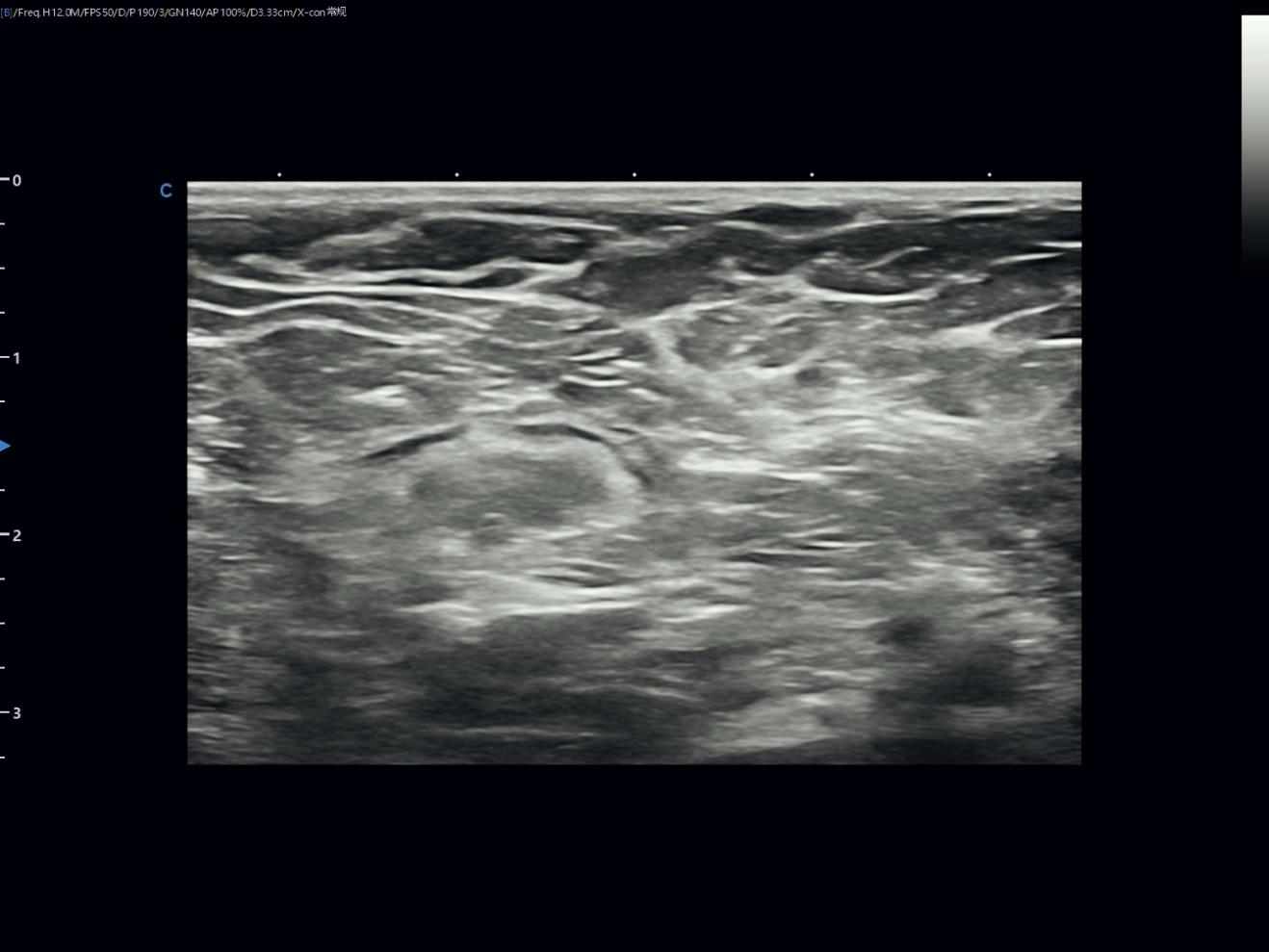 Reading a Small Breast Nodule with Confidence Reading a Small Breast Nodule with Confidence