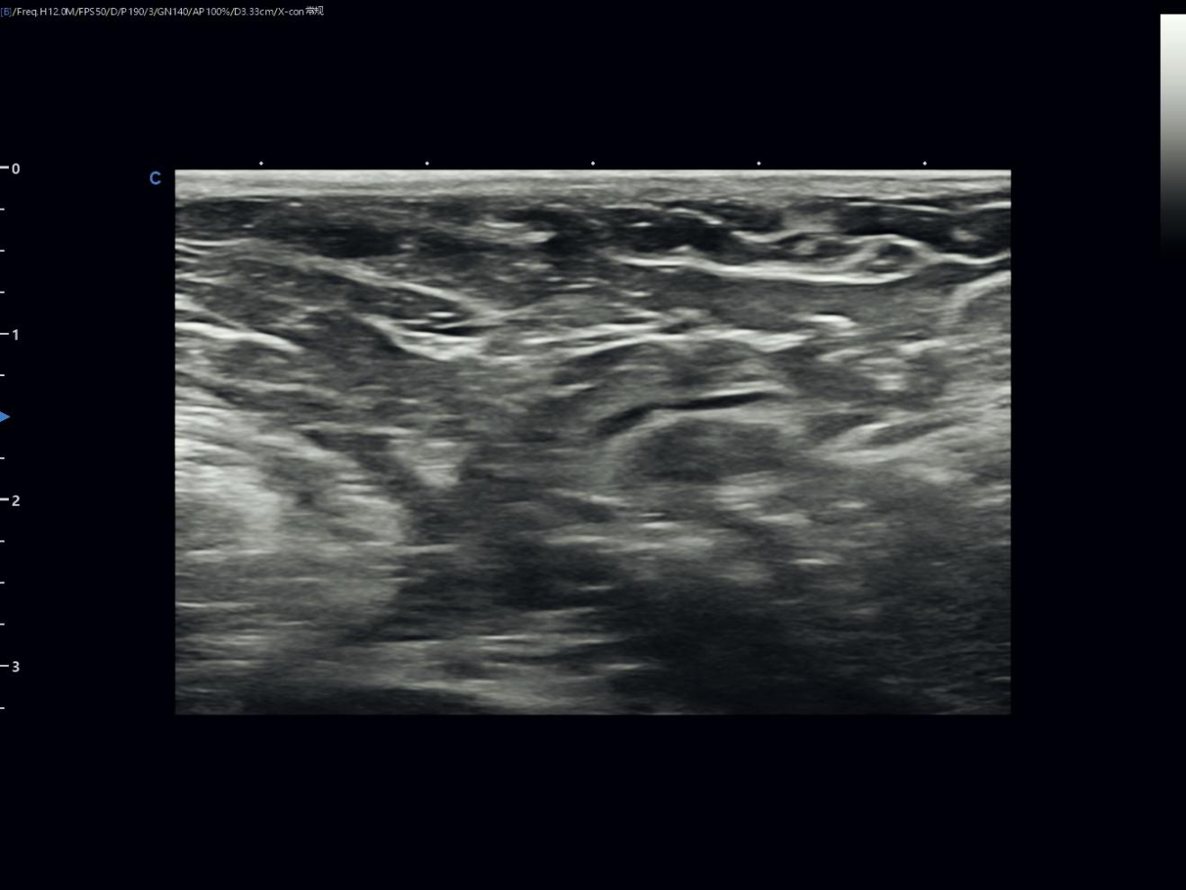 Reading a Small Breast Nodule with Confidence Reading a Small Breast Nodule with Confidence