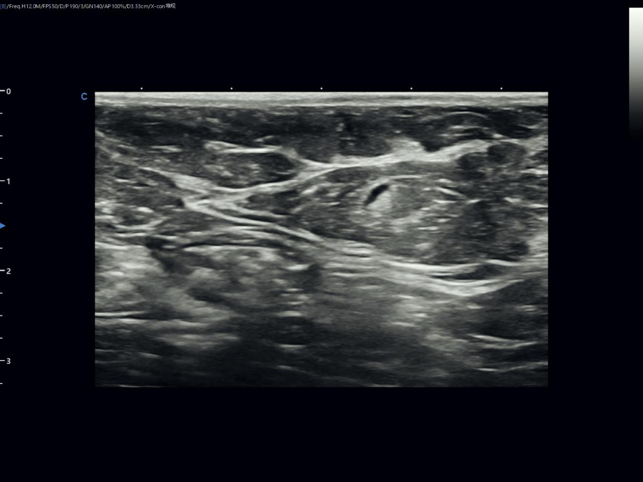 Reading a Small Breast Nodule with Confidence Reading a Small Breast Nodule with Confidence