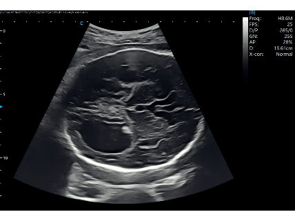 Fetal Lateral Ventricle Dilatation on Prenatal Ultrasound