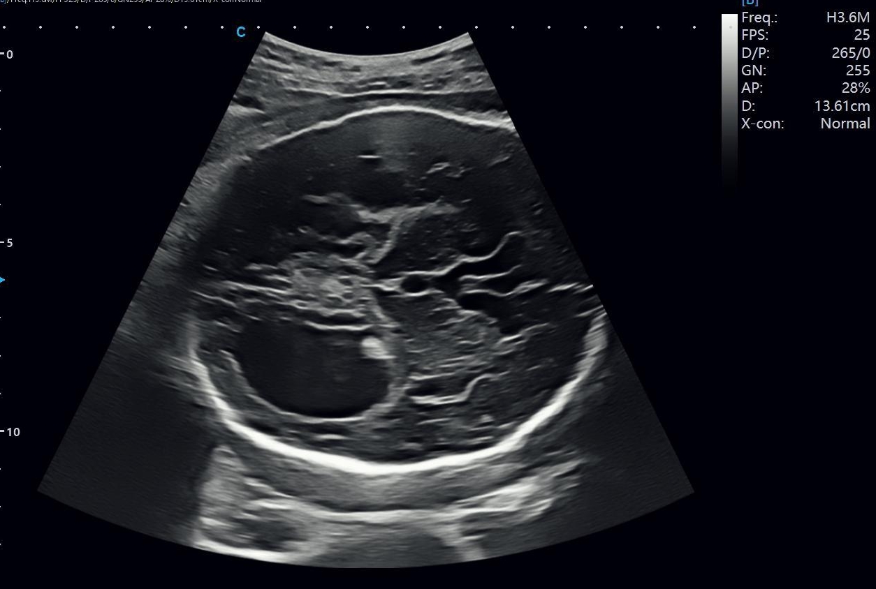 Fetal Lateral Ventricle Dilatation on Prenatal Ultrasound