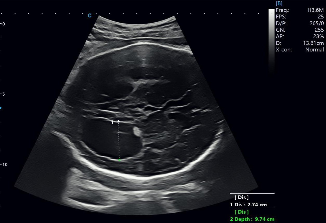 Fetal Lateral Ventricle Dilatation on Prenatal Ultrasound